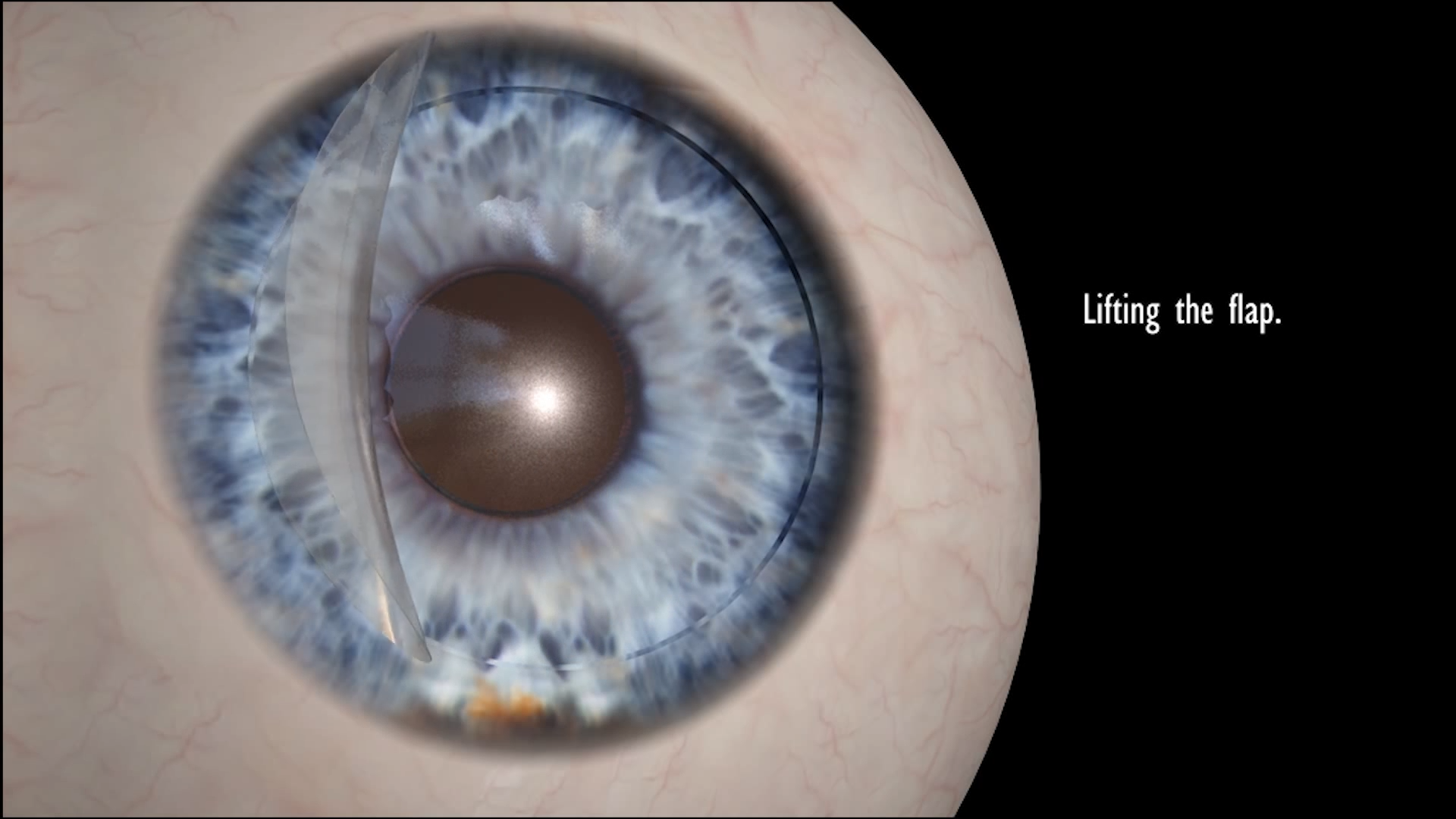 eyeball