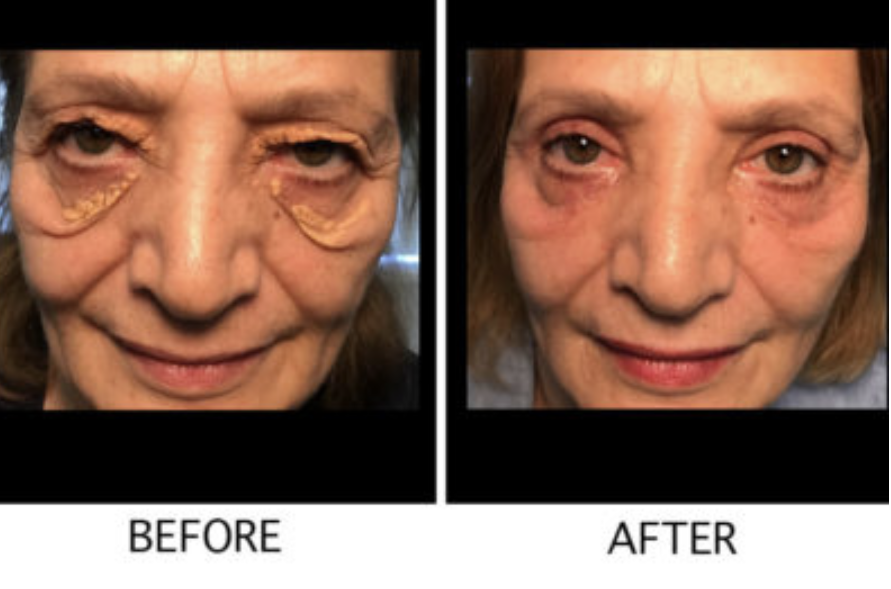 Xanthelasma Palpebrum Before & After Gallery - Patient 54327436 - Image 1