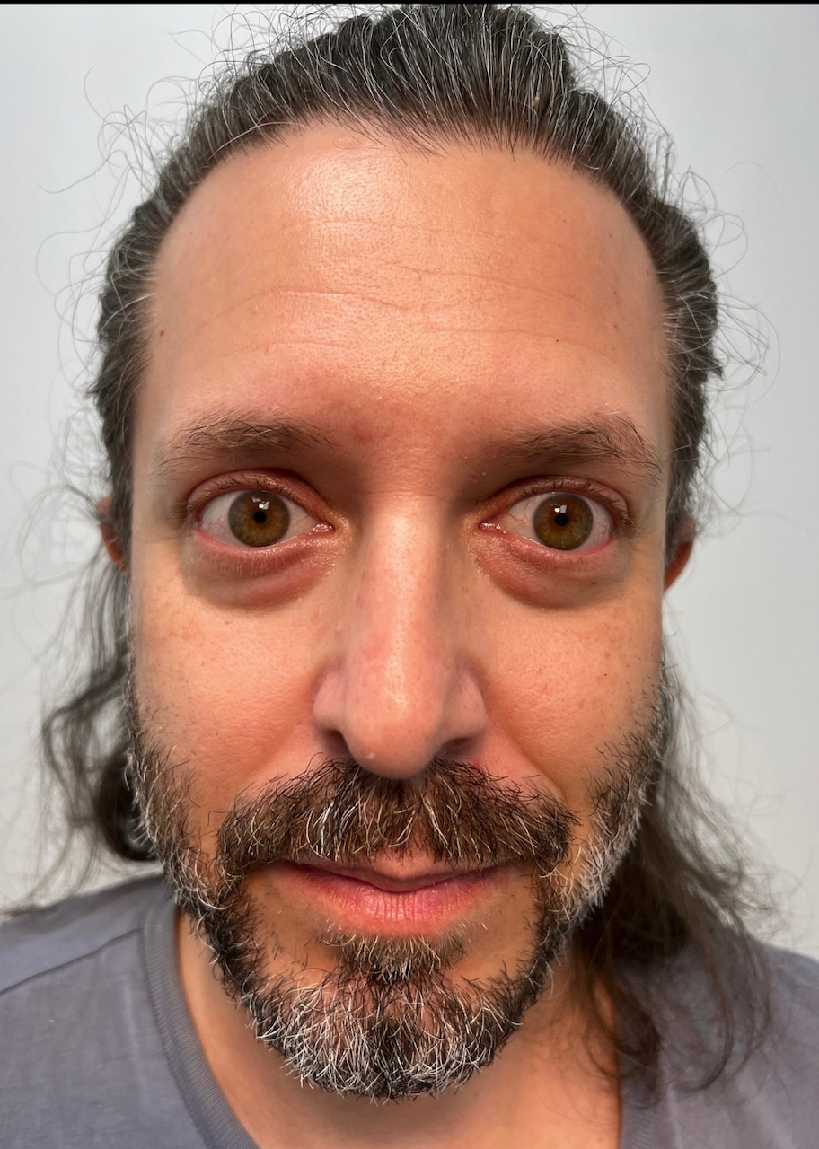 blepharoplasty eyelid surgery