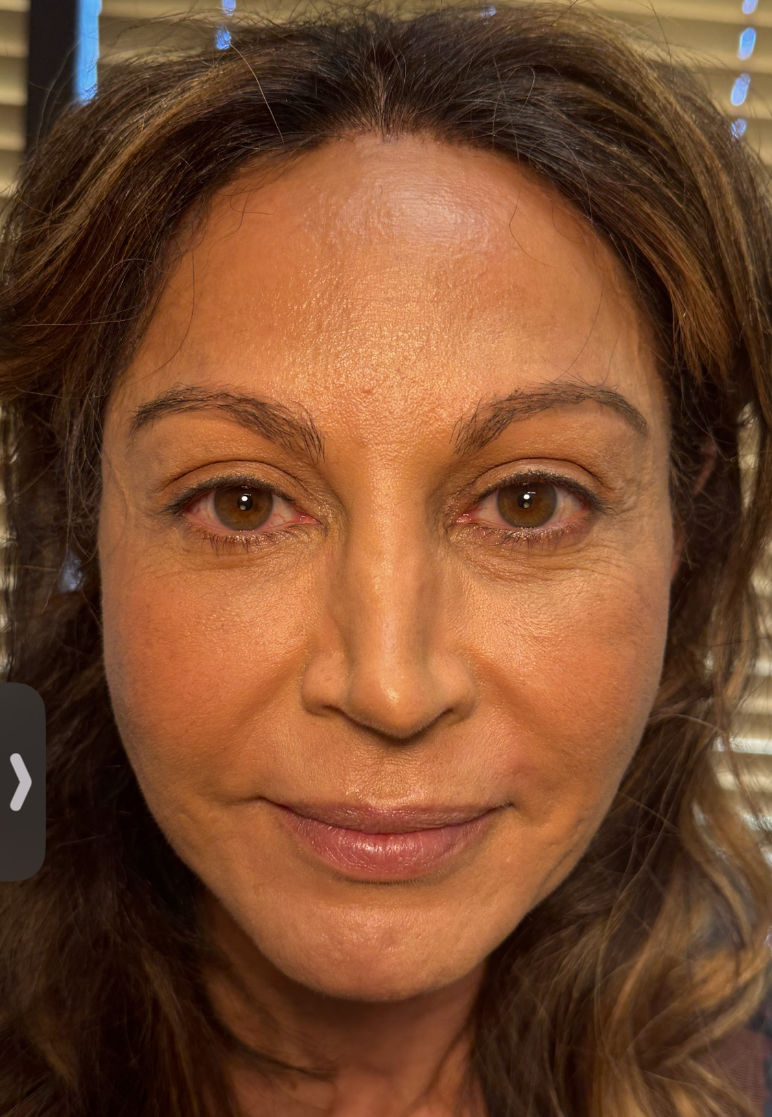 blepharoplasty