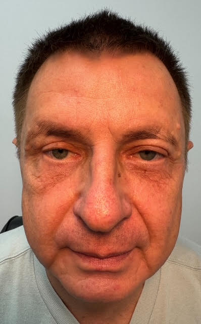 blepharoplasty eyelid surgery